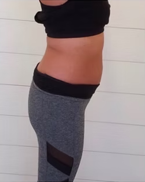 Tummy — Side View 1 After