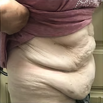 Tummy — Side View 2 Before