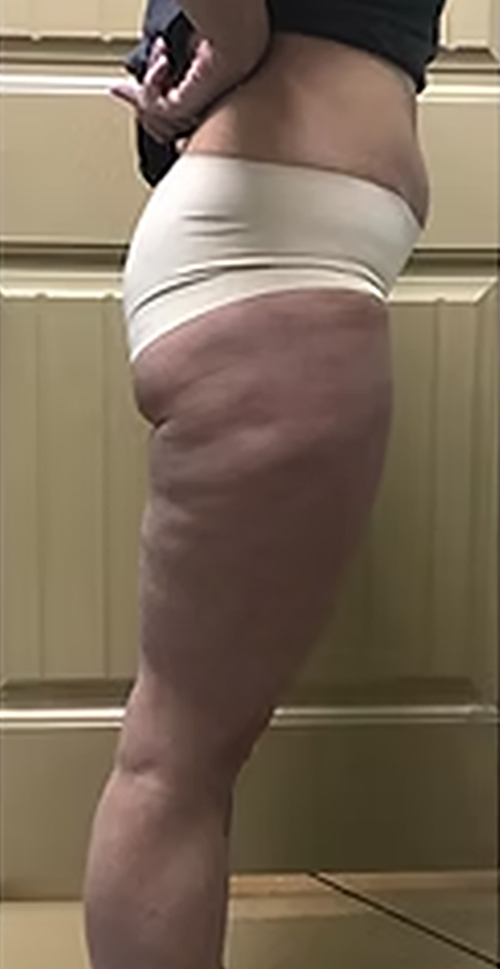 Lower Body — Side View Before