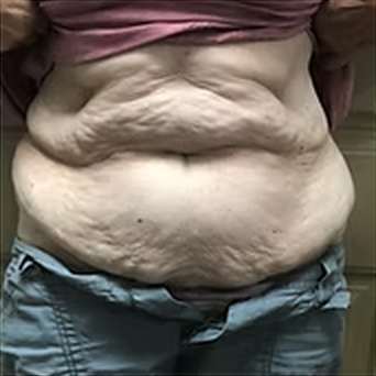 Tummy — Front View Before